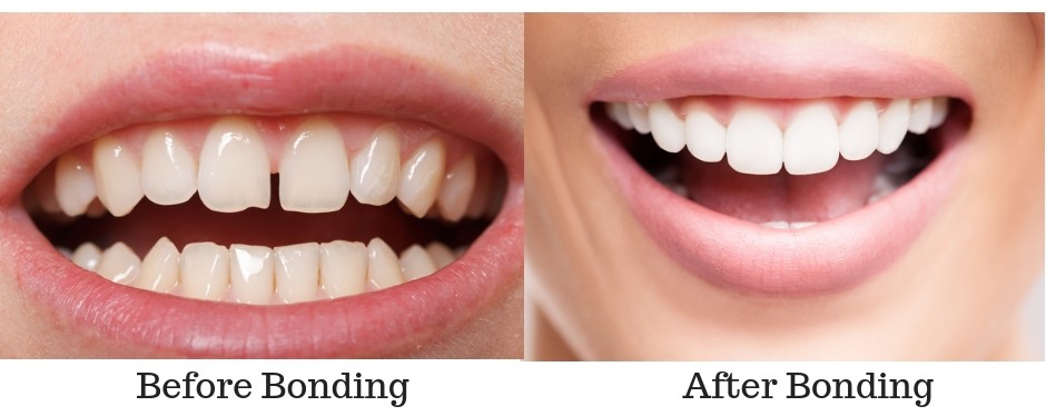 What Are The Differences Between Composite Resin Bonding & Veneers?