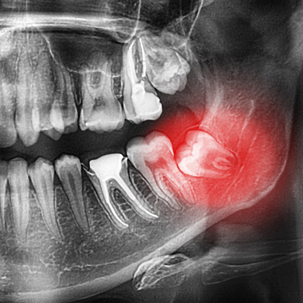 Dental Xray