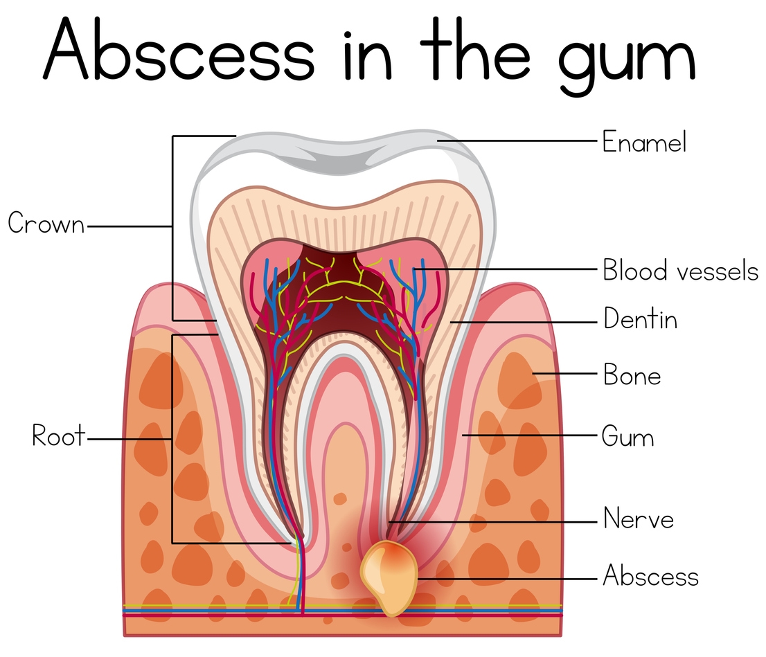 abscess gum