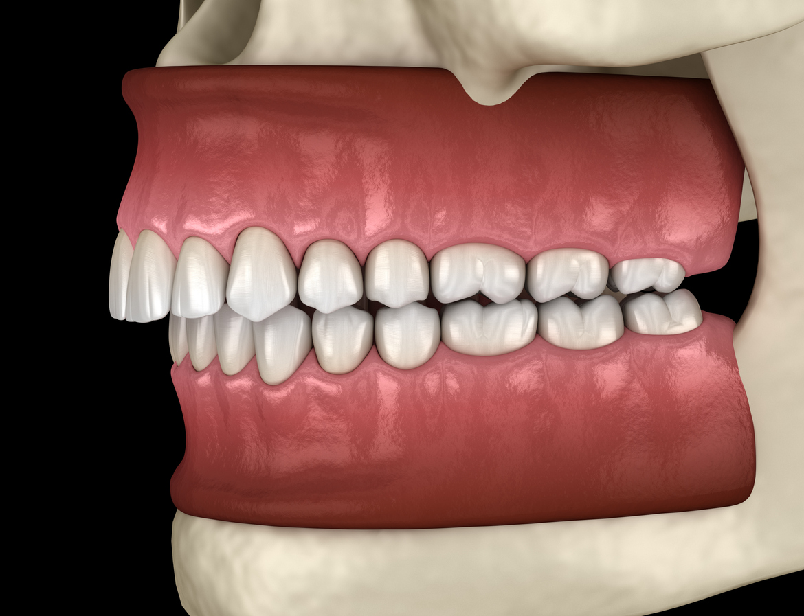 What is Malocclusion of the Teeth and How Can it be Treated?