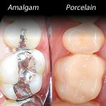 types of dental filings