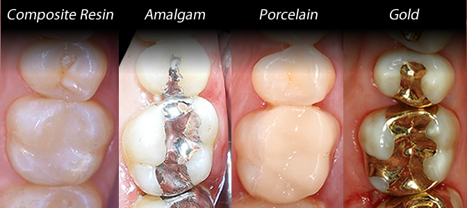 types of dental filings