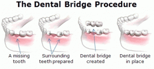 dental-bridge