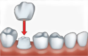 dental-crowns