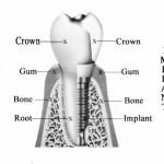 Dental Implant Carrum Downs