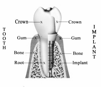 Dental Implant Carrum Downs