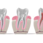 root canal treatment