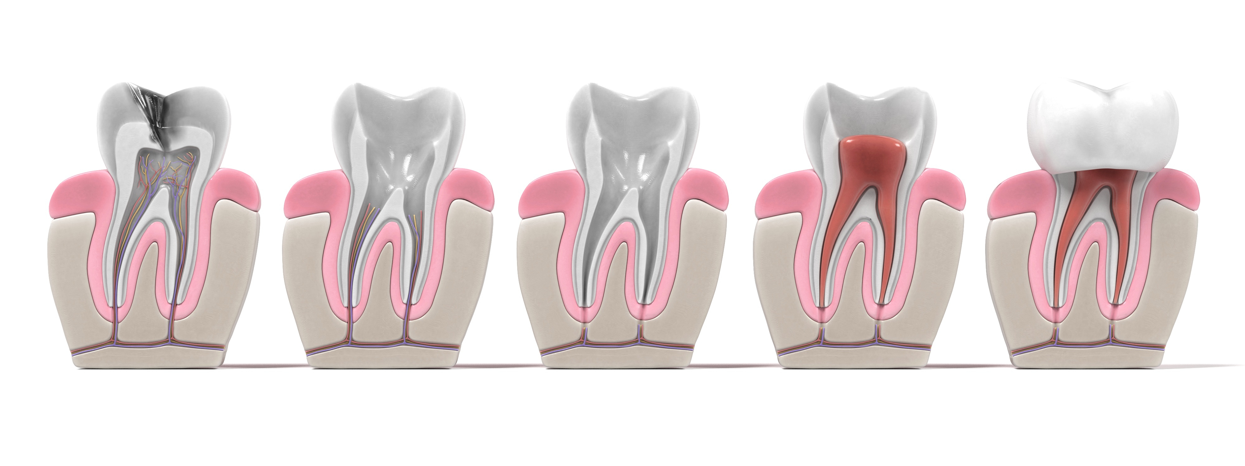 root canal treatment