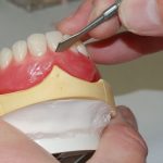 All You Need to Know About Denture Repairs