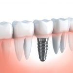 Dental Implants, Bridges and Dentures