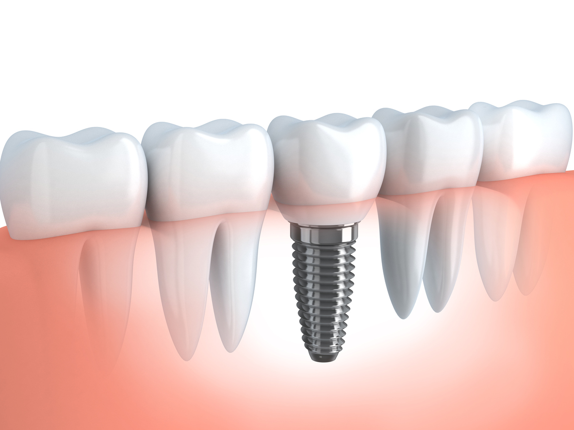 Dental Implants, Bridges and Dentures