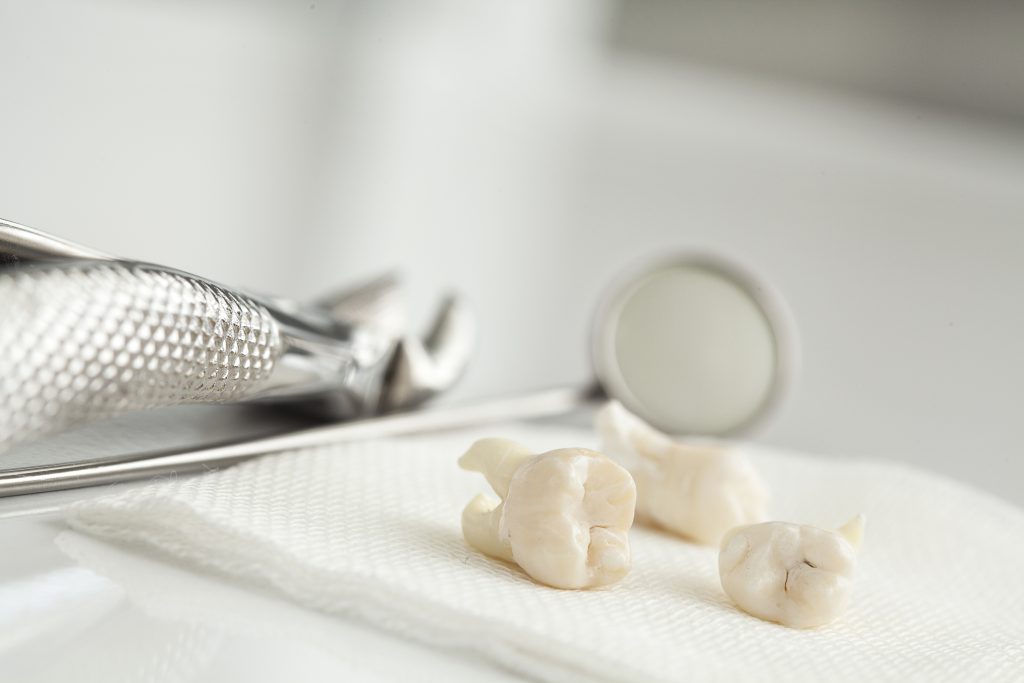 Tooth extraction: All you need to know