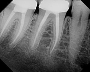 root canal xray at Carrum downs