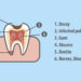 FAQ - Root Canal