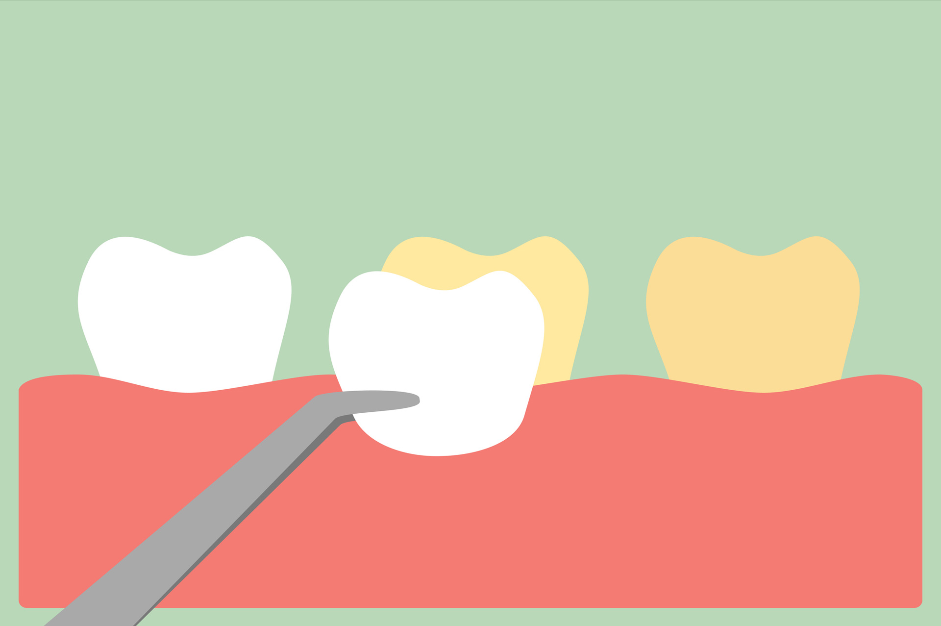 Pros and Cons of Veneers