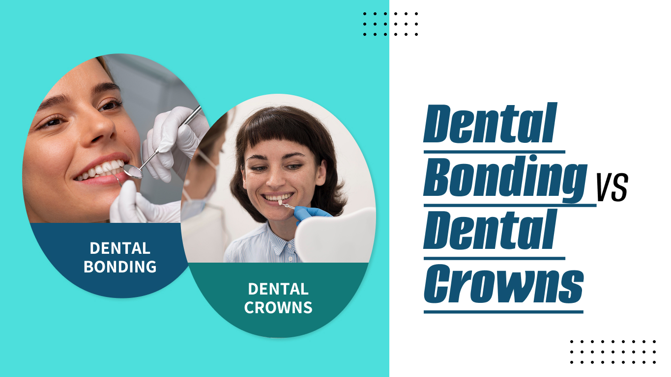 Bonding vs crowns