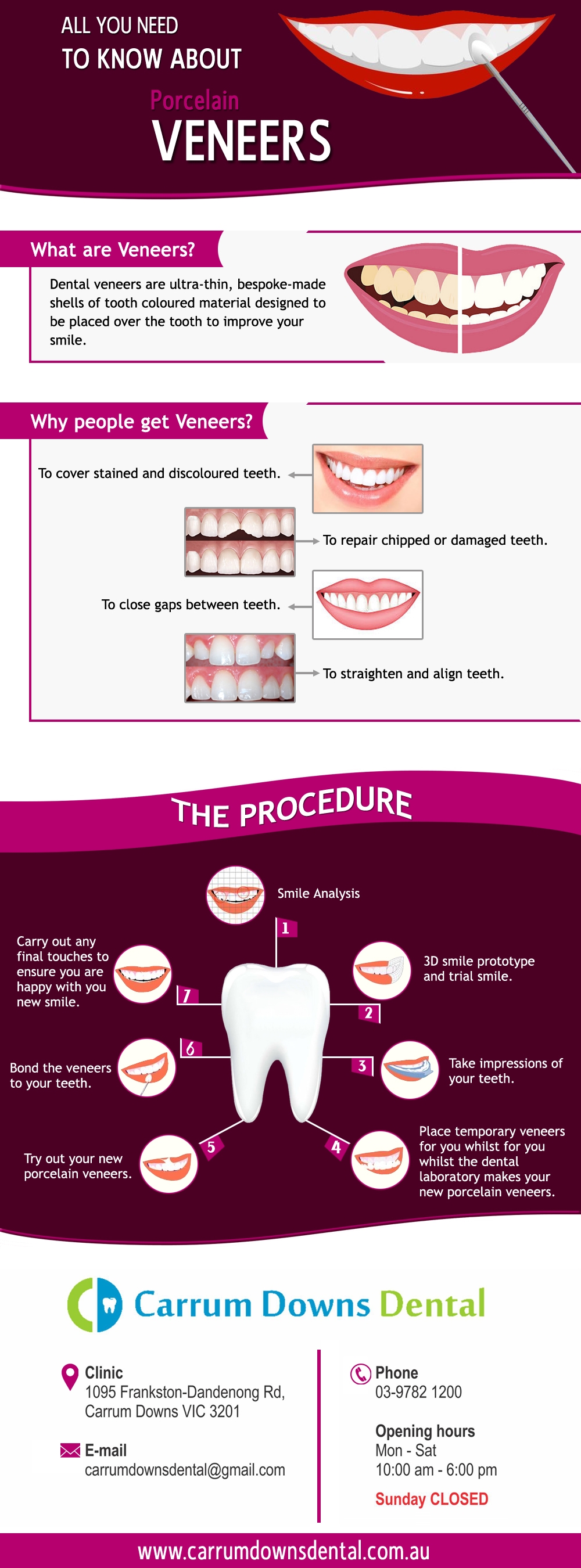 Veneers Carrum Downs