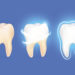 Teeth Cleaning Carrum Downs