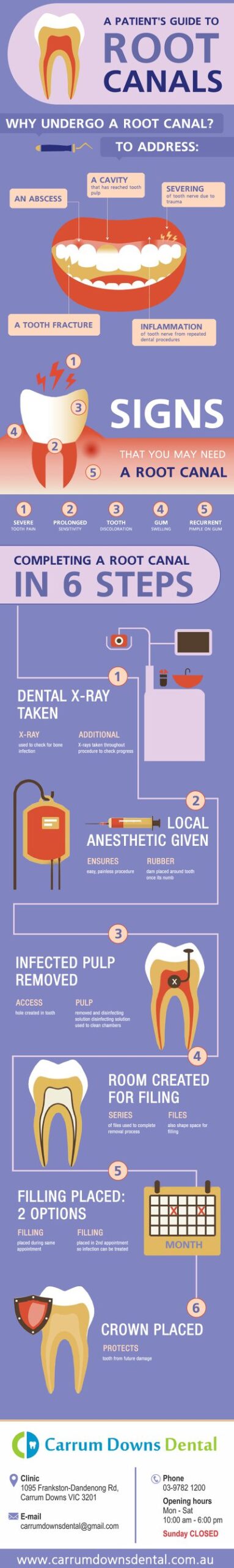 A Patient’s guide to Root Canals