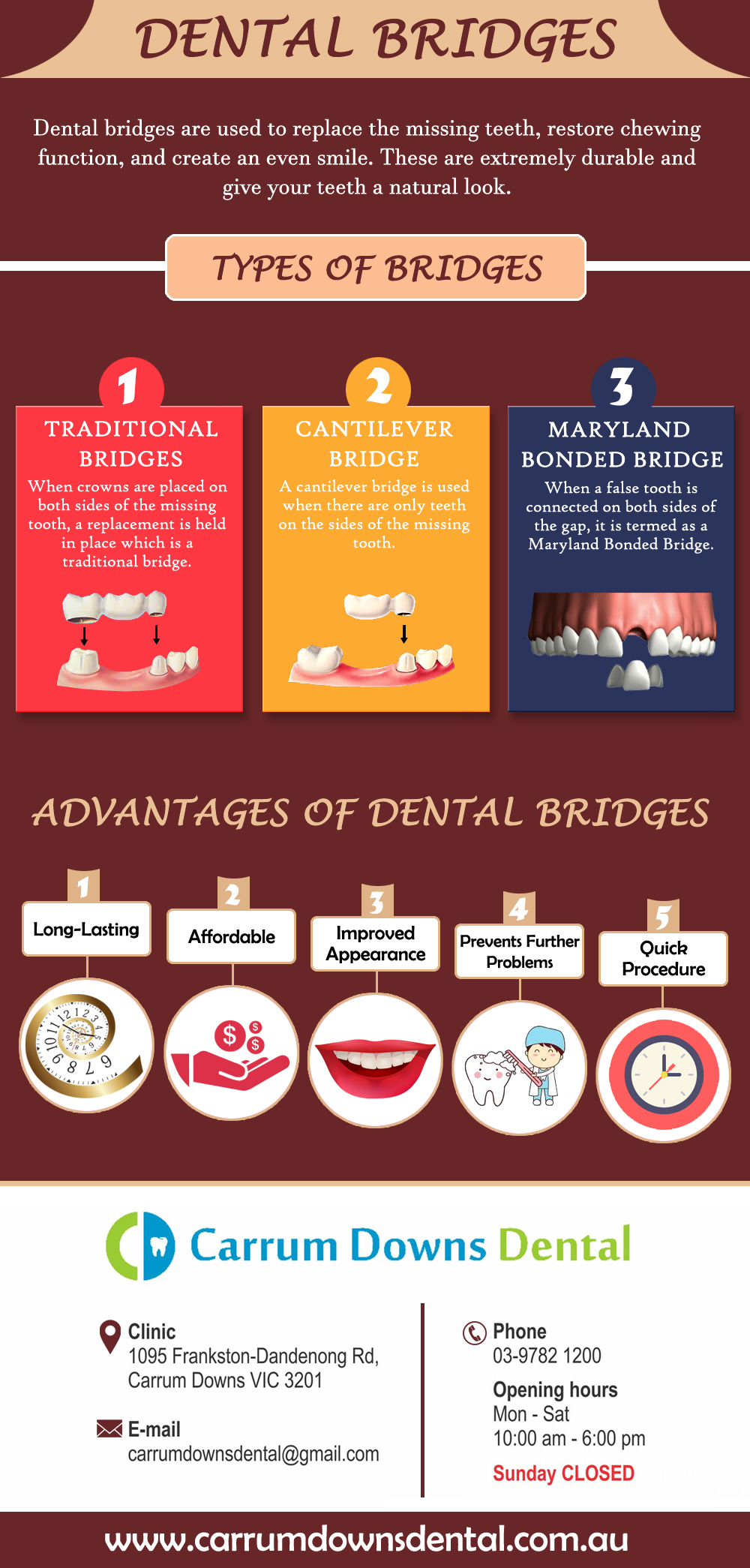 Advantages of Dental Bridges