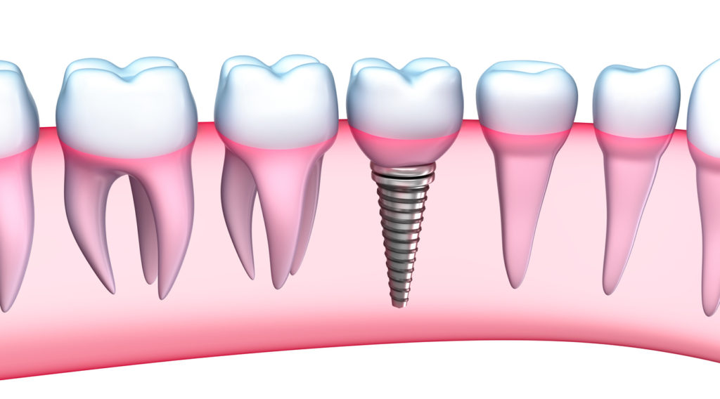 Dental implant