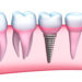 Dental implant