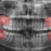 Wisdom Tooth Extraction