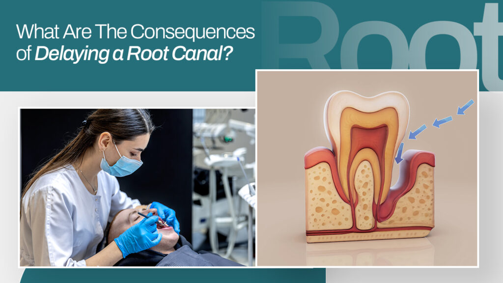 What Are The Consequences of Delaying a Root Canal