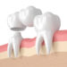 Dental Crowns and Bridges