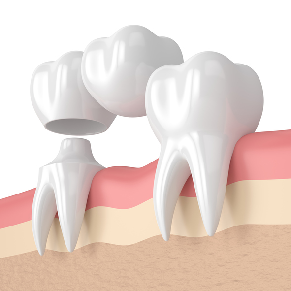 Dental Crowns and Bridges