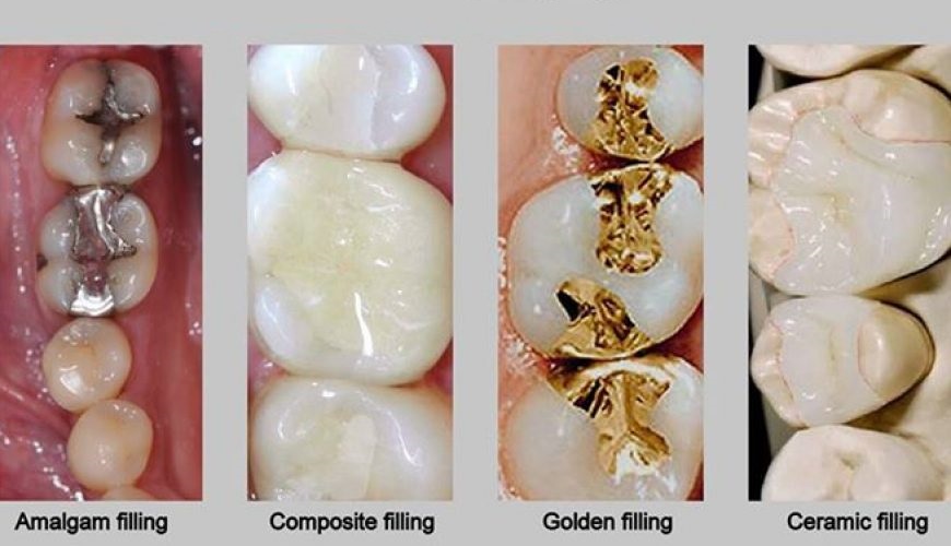 Dental Filling: What Happens When You Get It Done