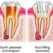 Root Canal