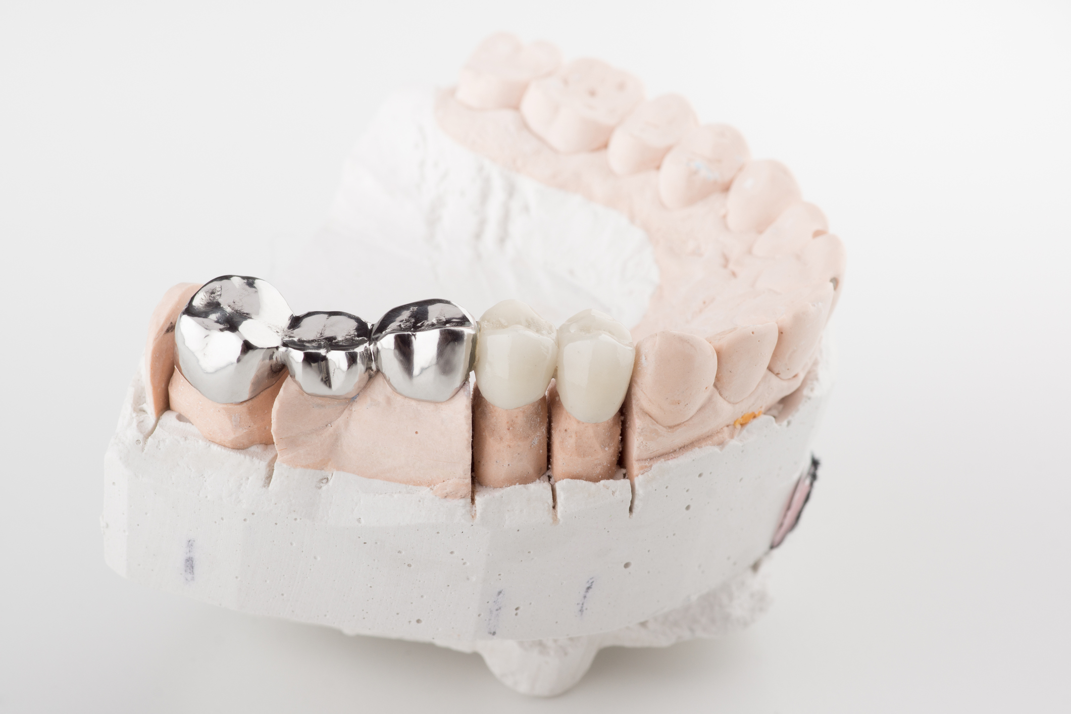 Bridged dental prostheses