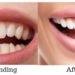 Dental Bonding Before and After