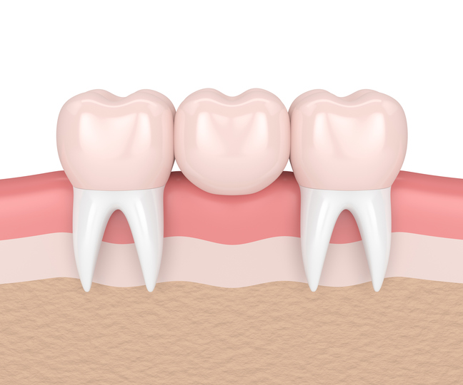 dental bridges