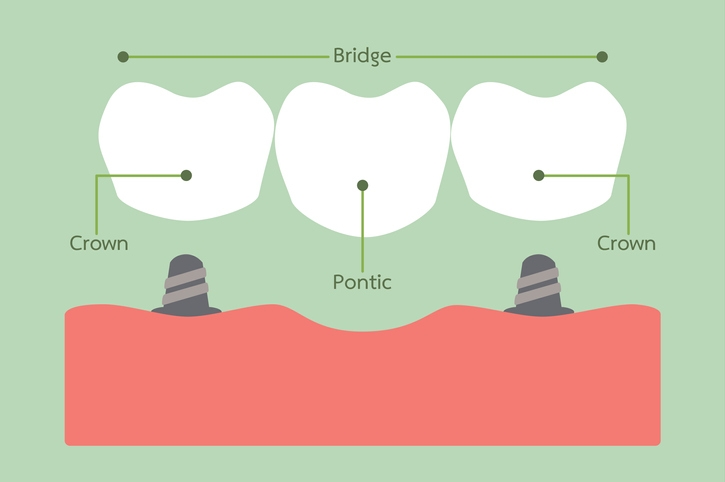 Dental Bridge Carrum Downs