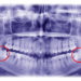 Wisdom Teeth X-ray