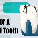 Dead Tooth