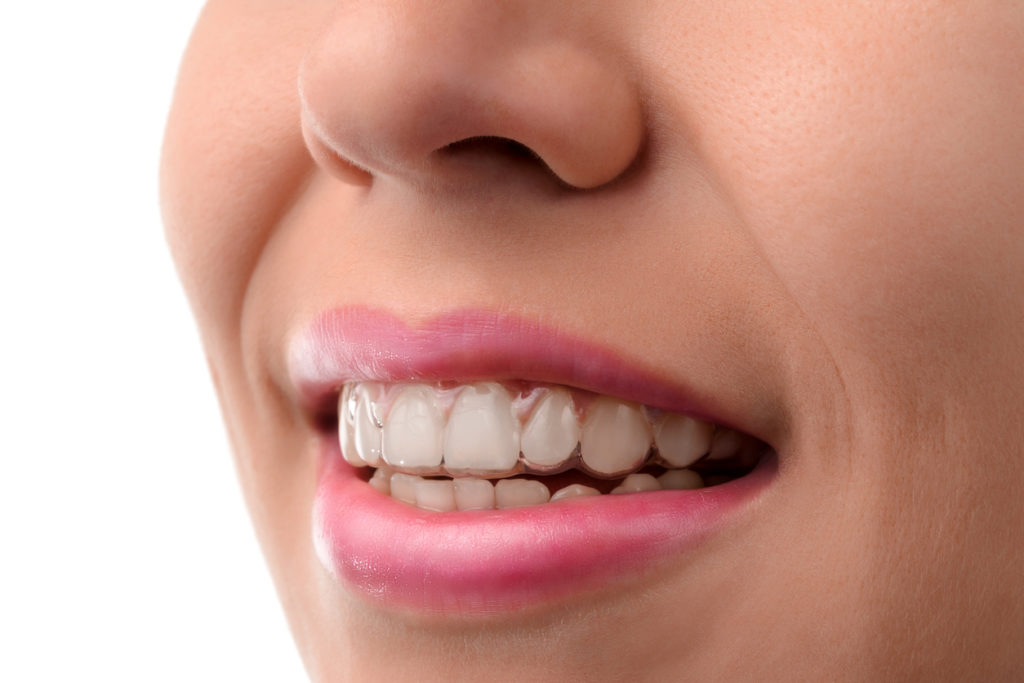 Why is Clear Aligners the best choice?  How to clean, clearcorrect aligners?