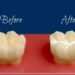 What Is The Difference Between Dental Sealants and Dental Fillings?