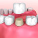 Dental crown installation process, Medically accurate 3d illustration