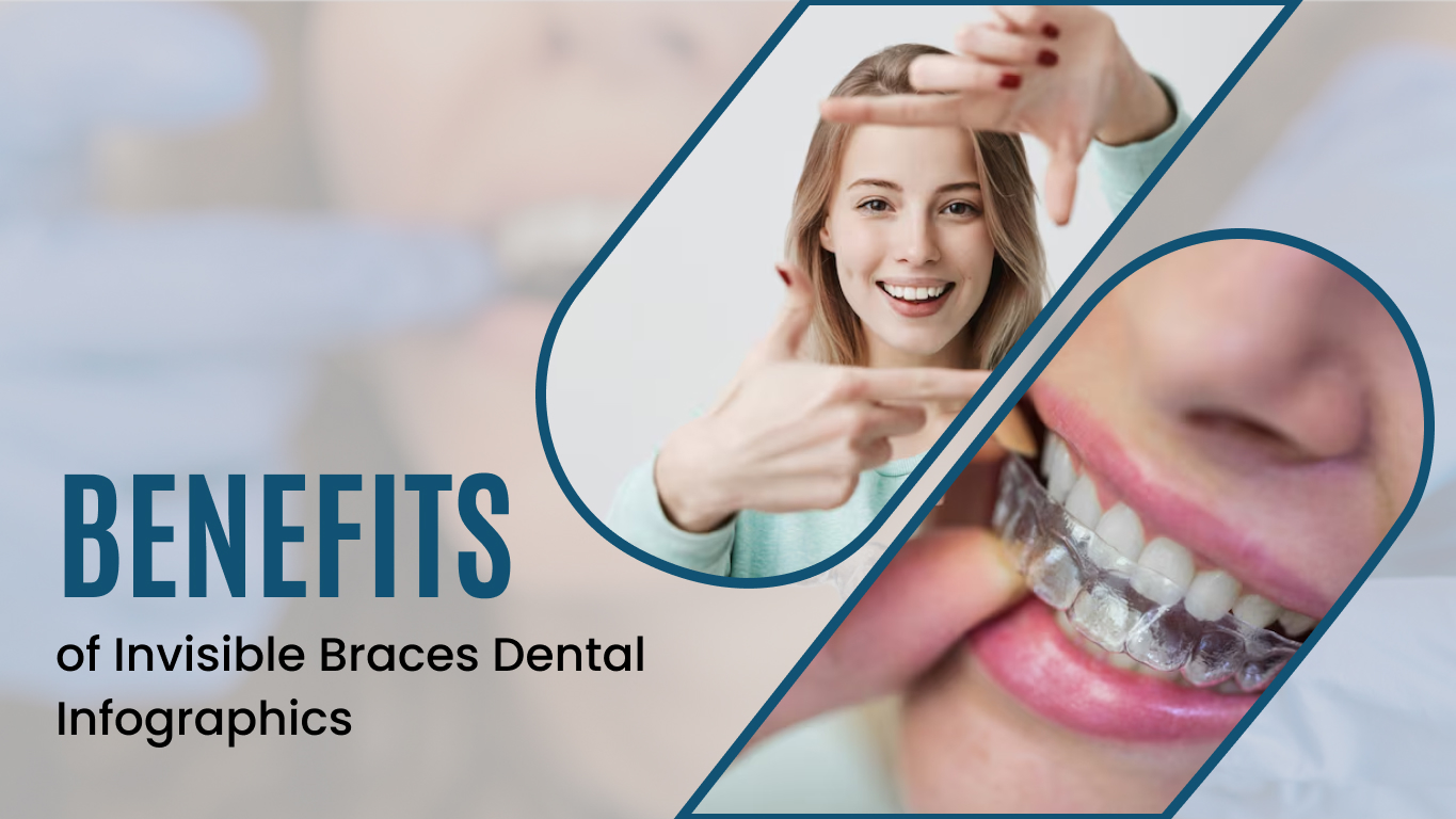 Invisible-Braces