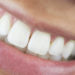 Tooth Enamel Damage