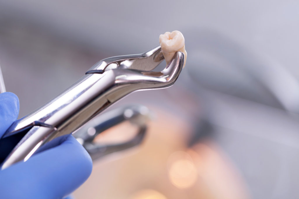 Know The Wisdom Teeth Removal Procedure and Complications