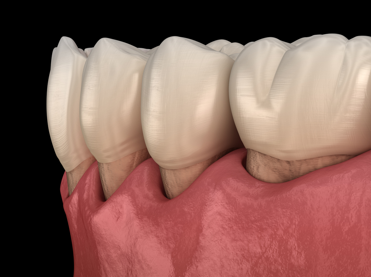 Gum Disease