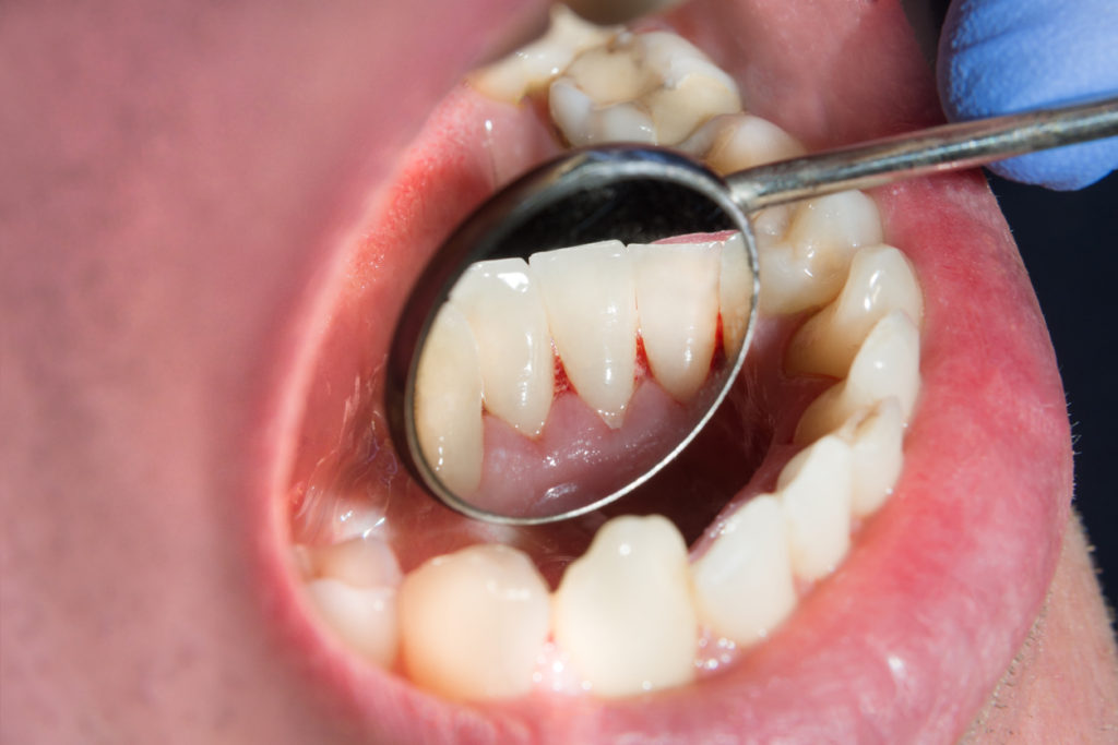 Gingivitis Treatment