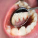 Gingivitis Treatment