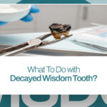 What To Do with Decayed Wisdom Tooth