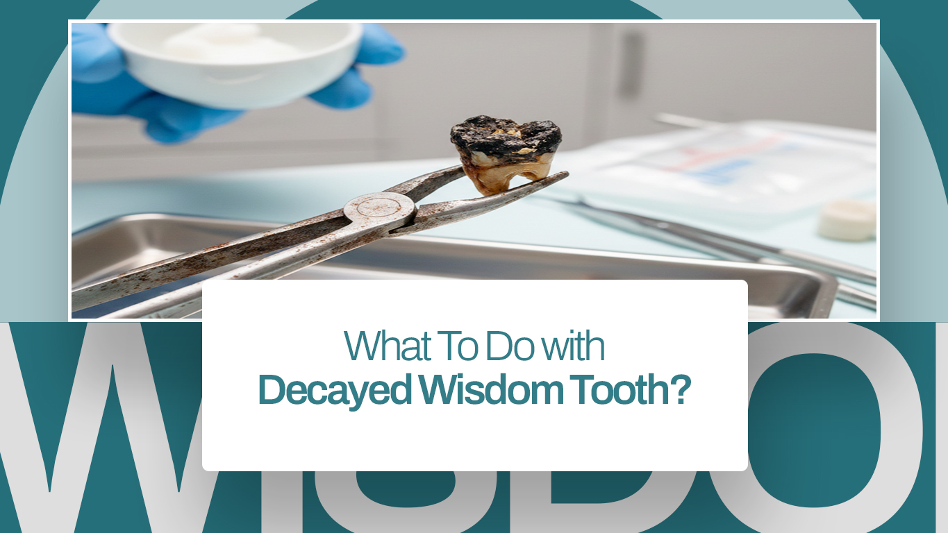 What To Do with Decayed Wisdom Tooth