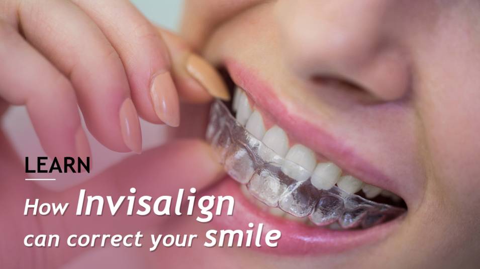 Invisalign can correct your smile